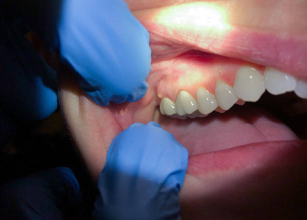 Best Emergency Tooth Extraction in Woxall, PA